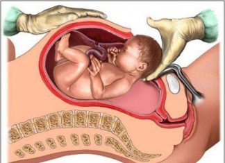 Các tai biến khi mổ đẻ.