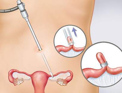 Triệt sản nữ giới, Thắt ống dẫn trứng, Tránh thai mãi mãi, Triệt sản bằng phẫu thuật, Triệt sản không bằng phẫu thuật, Ưu và nhược điểm của triệt sản nữ