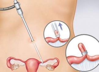 Triệt sản nữ