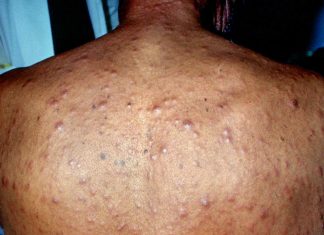Bệnh giang mai với phụ nữ mang thai và trẻ sơ sinh.