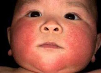 Bệnh chàm ở trẻ em