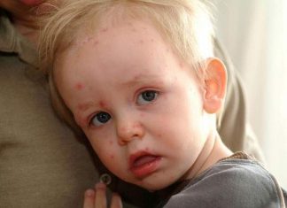 Chăm sóc bé bị thủy đậu thế nào?