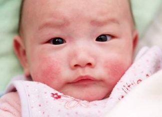 Chàm ở trẻ nhỏ – Biểu hiện và cách chữa trị