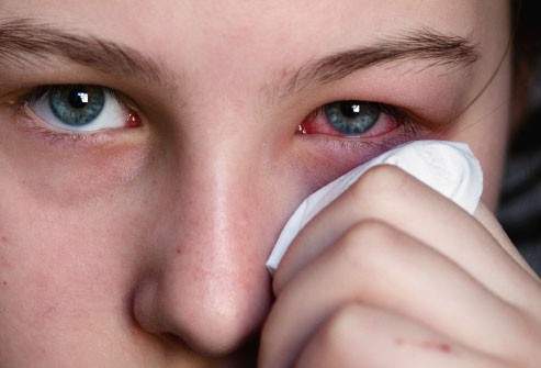 bệnh đau mắt đỏ, đau mắt đỏ với thai, mang thai, viêm kết mạc, ngứa và đỏ mắt, 