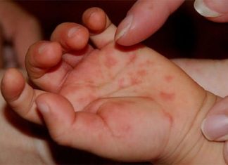 Bệnh chân tay miệng ở trẻ