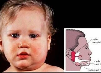 Nguyên nhân và biến chứng quai bị ở trẻ