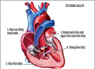 Hẹp động mạch phổi.