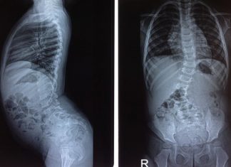 Cong vẹo cột sống ở trẻ