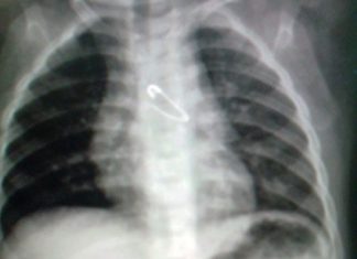 Dị vật đường thở, một tai nạn thường gặp ở trẻ nhỏ