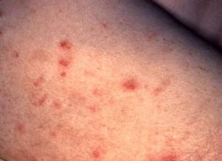 Các giai đoạn phát triển của bệnh giang mai.