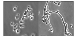 Viêm âm đạo do nấm Candida.