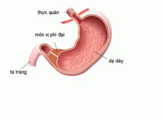 Hẹp môn vị phì đại ở trẻ