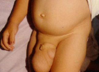 Thoát vị bẹn ở trẻ nhỏ
