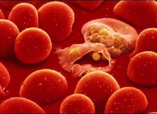 Thiếu máu tan máu bẩm sinh ở trẻ – Thalassemia