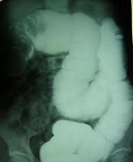 Lồng ruột ở trẻ nhỏ