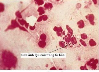 Bệnh lậu với phụ nữ mang thai và trẻ sơ sinh