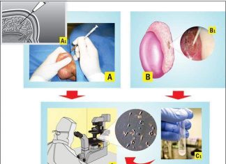 Chọc hút tinh trùng từ mào tinh hoàn trong điều trị vô sinh nam