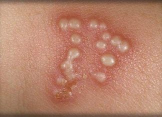Lây nhiễm mụn rộp sinh dục ở trẻ sơ sinh