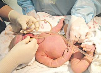 Hội chứng hít ối phân su ở trẻ sơ sinh.