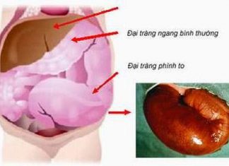 Phình đại tràng ở trẻ sơ sinh
