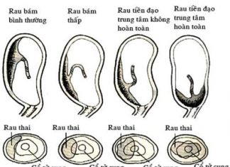 Bệnh lý rau tiền đạo ở phụ nữ mang thai
