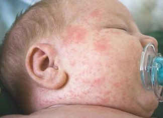 Bệnh rubella ở trẻ nhỏ