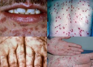 Các ảnh hưởng của bệnh Giang mai