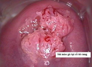 Sùi mào gà và ung thư cổ tử cung.