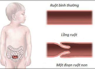 Lồng ruột ở trẻ