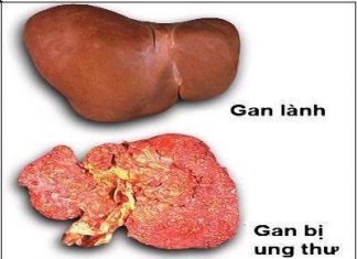 Viêm gan B và ung thư gan