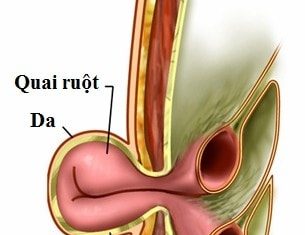 Thoát vị rốn ở trẻ sơ sinh nhận biết thế nào?