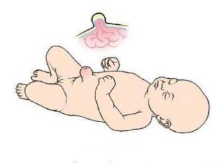 Thoát vị rốn ở trẻ sơ sinh