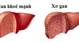 Những biến chứng nguy hiểm của viêm gan B