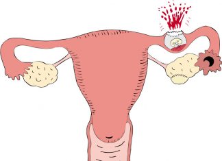 Thai ngoài tử cung nguy hiểm như thế nào?